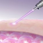 Multidimensional Applications of CO2 Lasers in Marking, Engraving, and Medical Aesthetics